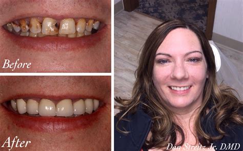 before and after photos of dental implants and cosmetic dentistry