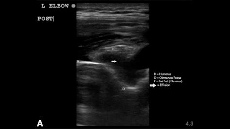 Arthrocentesis Of The Elbow Joint Internet Book Of Msk Ultrasound