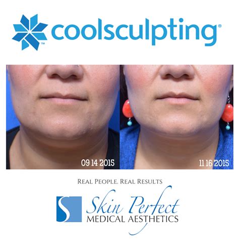 Coolsculpting Center In Whittier Under Chin Double Chin Reduction