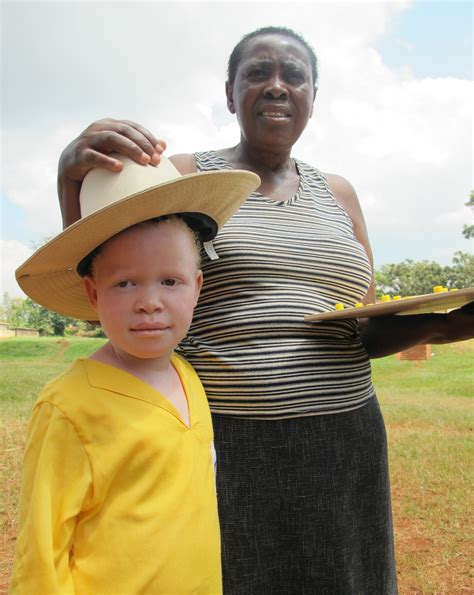 Education For Children With Albinism Advantage Africa