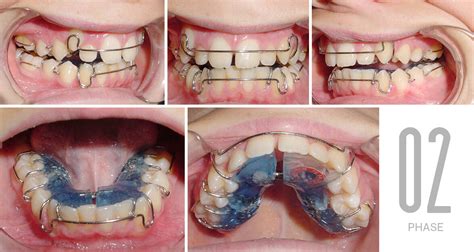 Speedbrackets, keramikbrackets, selbstligierende oder kassenbrackets? Herausnehmbare Zahnspange | Adjami Orthodontics