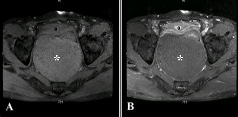 Cureus A Rare Case Of Presacral Epidermoid Cyst In An Adult Male