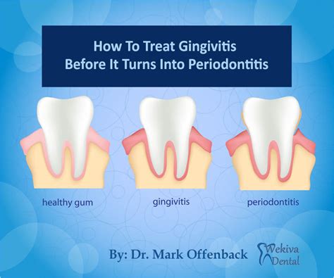 Gingivitis Treatment How To Treat Gingivitis Before It Turns Into