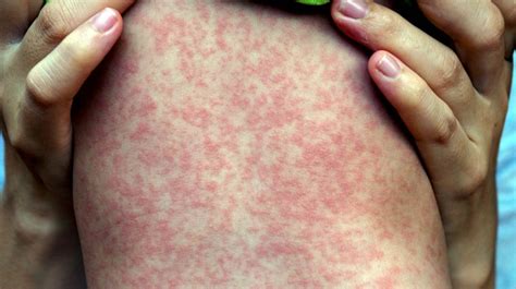 Another 10 Common Skin Rashes With Photos Health Service Navigator