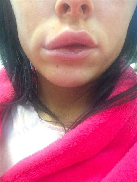 Woman Feared Shed Go Blind After Lip Exploded And Spread Filler