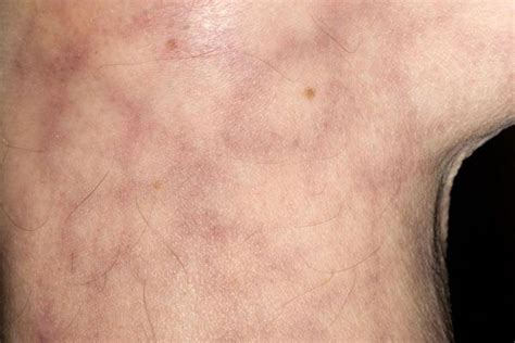 A Mottled Bluish Discoloration Of The Skin That Occurs In A Netlike Pattern That Is Not A