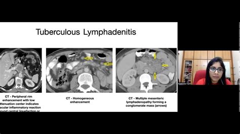 Sweehoney Vujjini Presents On Abdominal Tuberculosis Imaging Youtube