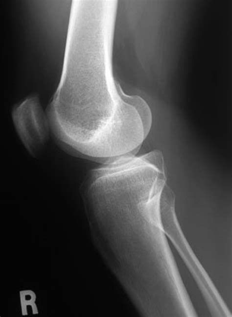 The Normal Knee X Ray What Are The Different Views