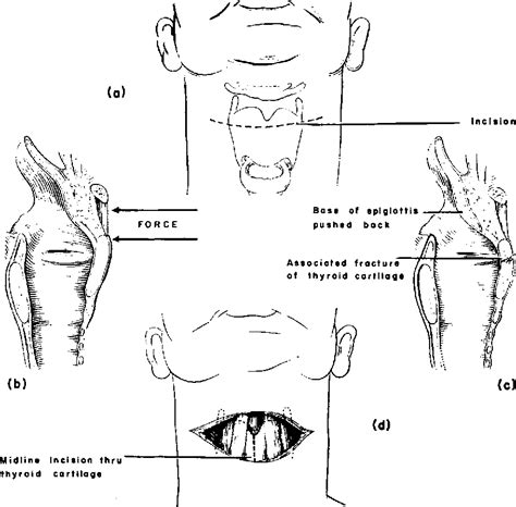 Figure 1 From Xlviii The Surgical Management Of Supraglottic And