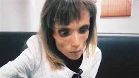 Watch Anorexic Woman Who Weighs Less Than 3 Stone Mocked By Doctors