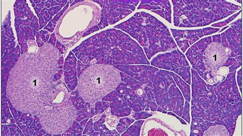 Under The Microscope Type 1 Diabetes Johns Hopkins Pathology