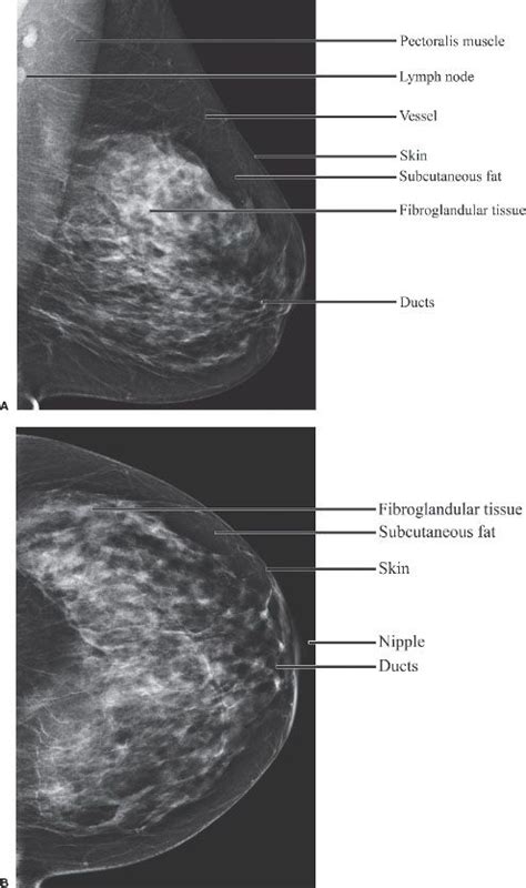 11 Breast Imaging Radiology Key