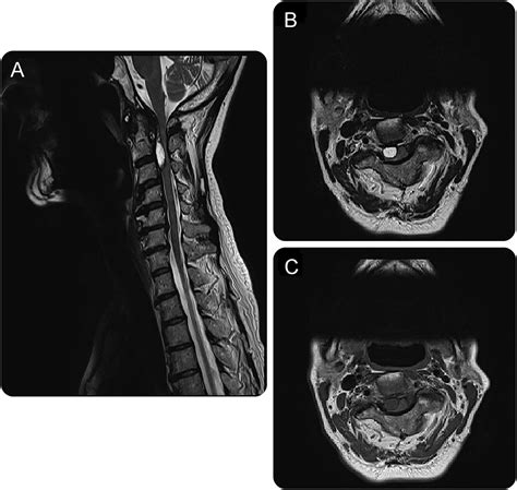 Teaching Neuroimages Intraspinal Synovial Cyst Causing Brown Séquard