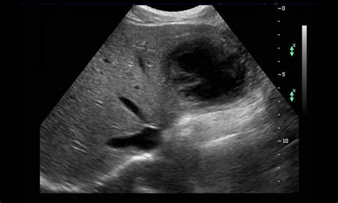 Ultrasound For Superficial Abscesses Treatment Sifsof