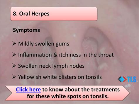 Ppt Causes Of White Spots On Tonsils You May Not Know Powerpoint