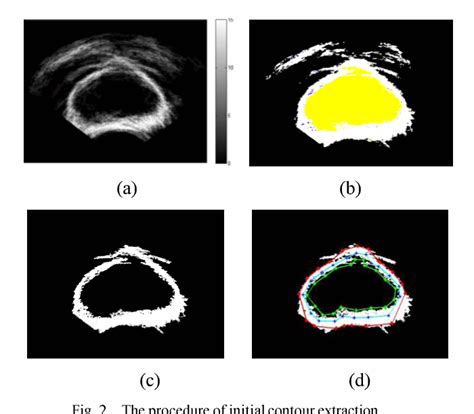 Figure 2 From Automatic Prostate Segmentation From Transrectal