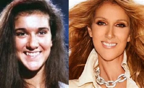 celine dion before and after plastic surgery face nose teeth