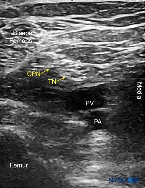 Ultrasound Guided Popliteal Sciatic Nerve Block Nysora Nysora