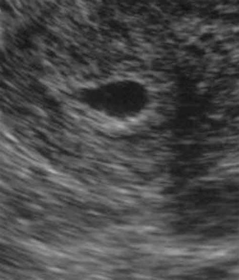 4 Weeks Pregnant Ultrasound Pictures Probability Of Getting Pregnant