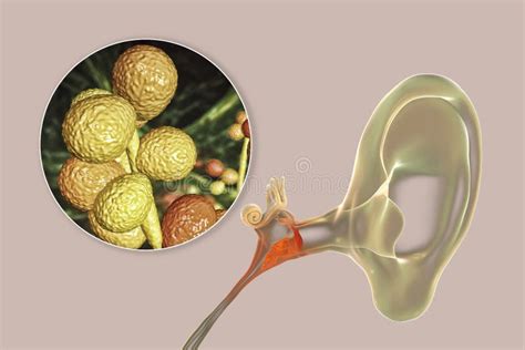 Chronic Suppurative Otitis Media Stock Illustration Illustration Of