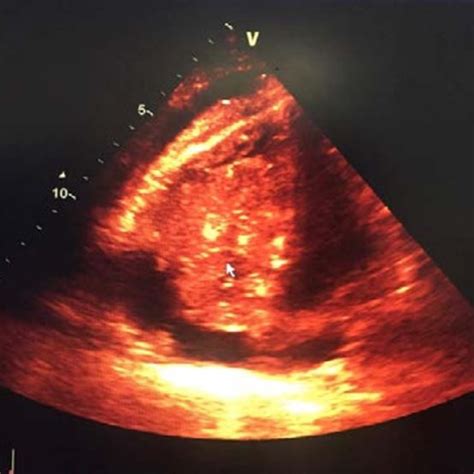 Image Of Two Dimensional Transthoracic Echocardiography Showing A
