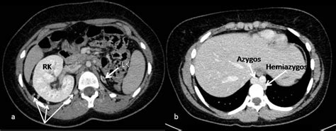 Case 2 Angio Ct Axial A Left Kidney Lk Hypoplasia With