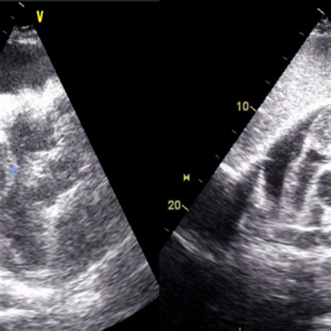 Two Dimensional Transthoracic Echocardiography In Subcostal View