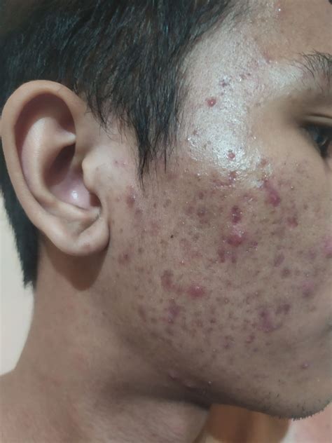 Please Help Me I Have A Severe Acne Condition General Acne