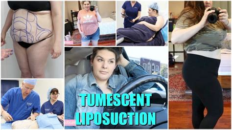 Tumescent Liposuction Post Op Results Youtube