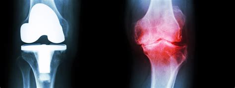 Osteoarthritis Causes Symptoms And Treatment