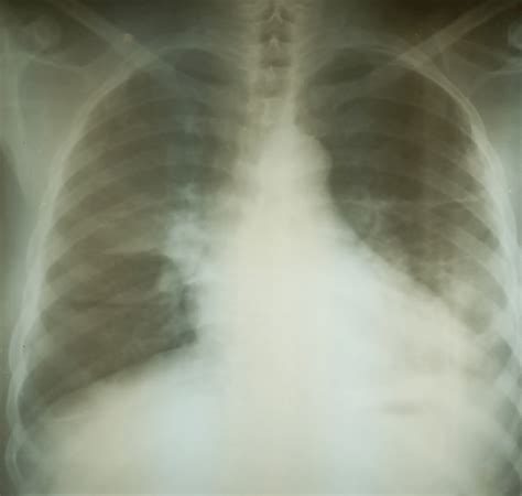 Chest X‐ray Showing Cardiomegaly Prominent Hilarupper Lobe Vascular