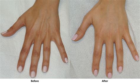 A Complete Guide To Hand Rejuvenation Treatments Center For