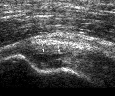 Ecografía Tendinosa De La Imagen A La Patología Radiología