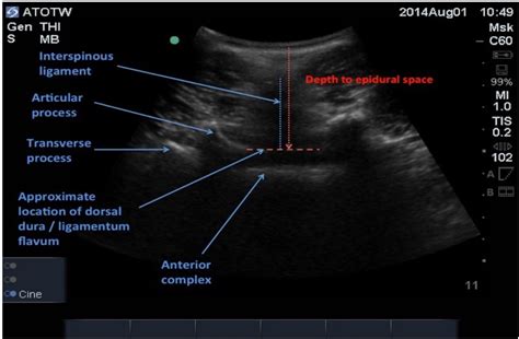 Ultrasound Guided Neuraxial Anaesthesia Wfsa Resources