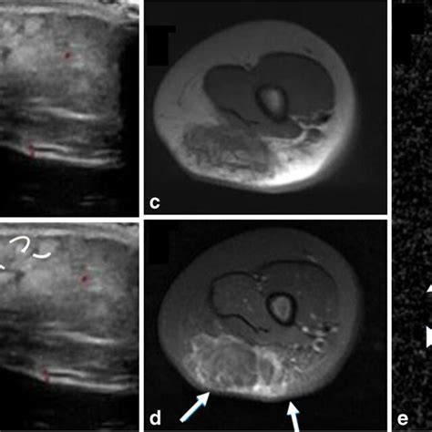 Fibrous Hamartoma Of Infancy Imaging Findings