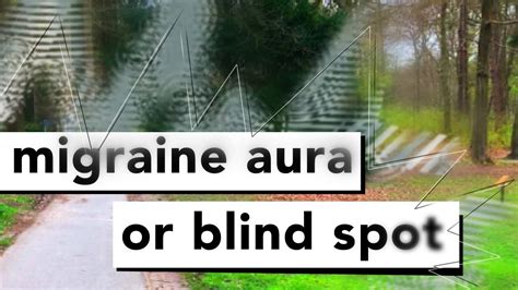 Visual Migraine Aura Scintillating Scotoma Blind Spot Simulation