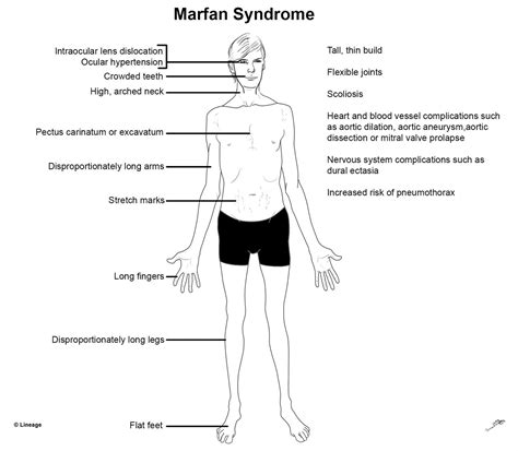 O Que é Síndrome De Marfan Edubrainaz