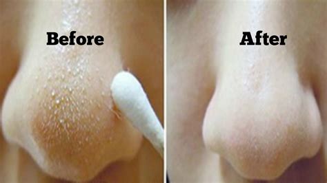 This handheld tool, which has. How to Get Rid of Blackheads & Whiteheads At Home in 7 ...