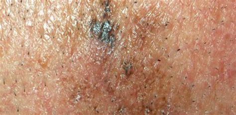 4 Stages Of Melanoma