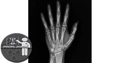 Anatomia Radiológica Da Mão Ossos E Articulações Youtube
