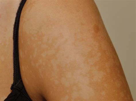 Tinea Versicolor Pityriasis Versicolor Pictures Symptoms Causes