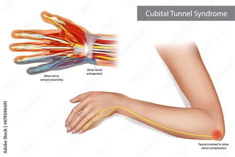 Medical Illustration To Explain Cubital Tunnel Syndrome Ulnar Nerve