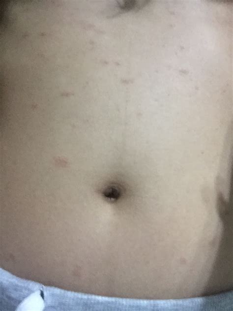 What Could Be The Cause Of Non Itchy Red Rashes On My Torso Photos
