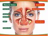 Images of Sinus Migraine Natural Treatment
