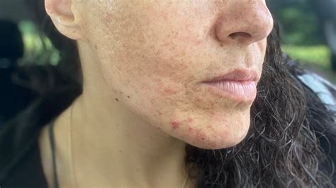 Hormonal Cystic Acne Specialist Puresthetics By Elle Youtube