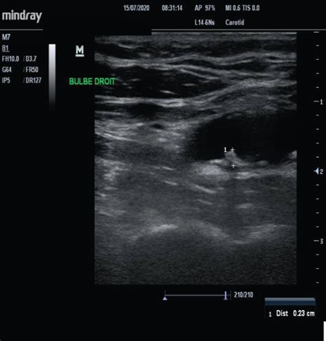 A Normal Carotid Artery Ultrasonography High Frequency Probe The