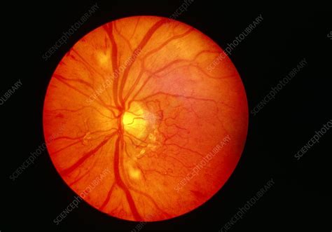 Ophthalmoscope Image Of A Normal Healthy Retina Stock Image P424