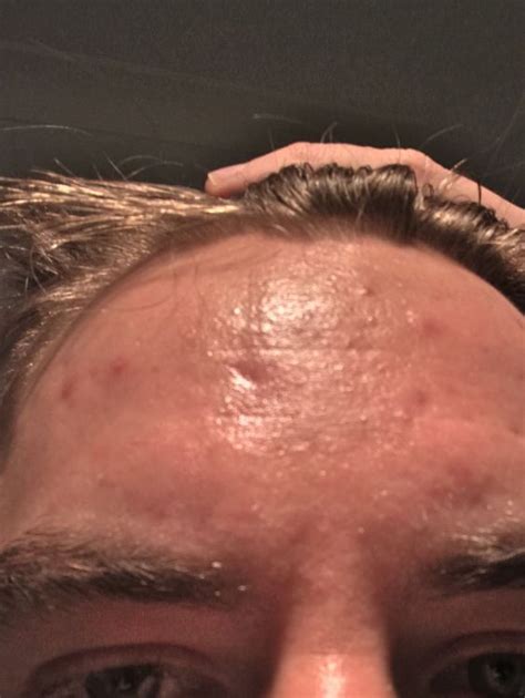 deep indentation   middle   forehead scar treatments acneorg