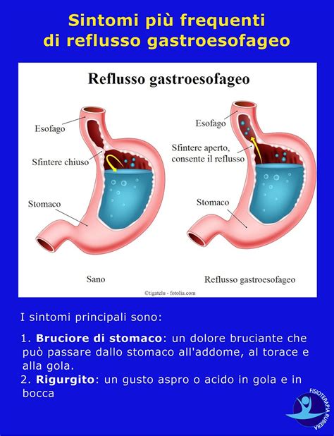Reflusso Gastroesofageo Cause Sintomi E Rimedi Naturali Sexiz Pix