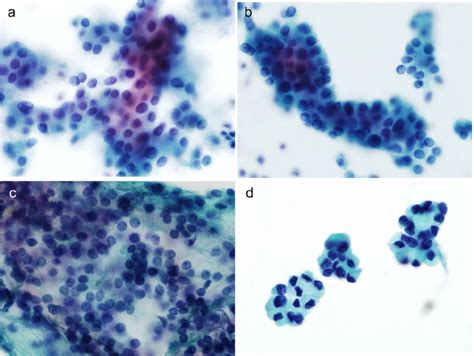 Liquid Based Cytology In Follicular Neoplasm Of The Thyroid Follicular